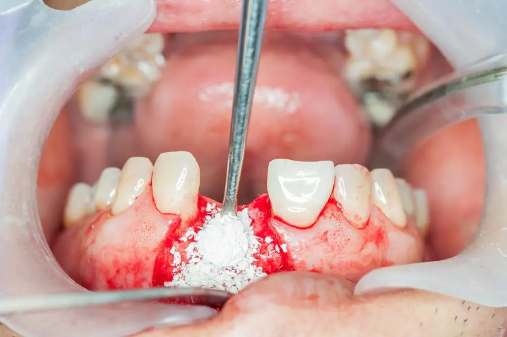 bone-grafting-2-1024x680