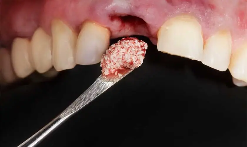 dental-bone-grafting-ihyderabad (1)
